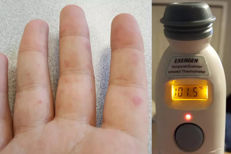 Coxsackie, also known as Hand Foot and Mouth Disease, can cause fever, sore throat, and sores/rash. (Photos: Dan Zarrow, Townsquare Media)