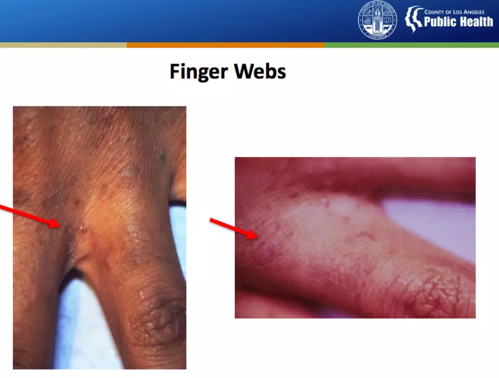 Scabies on finger webs. (Los Angeles County Health Dept.)