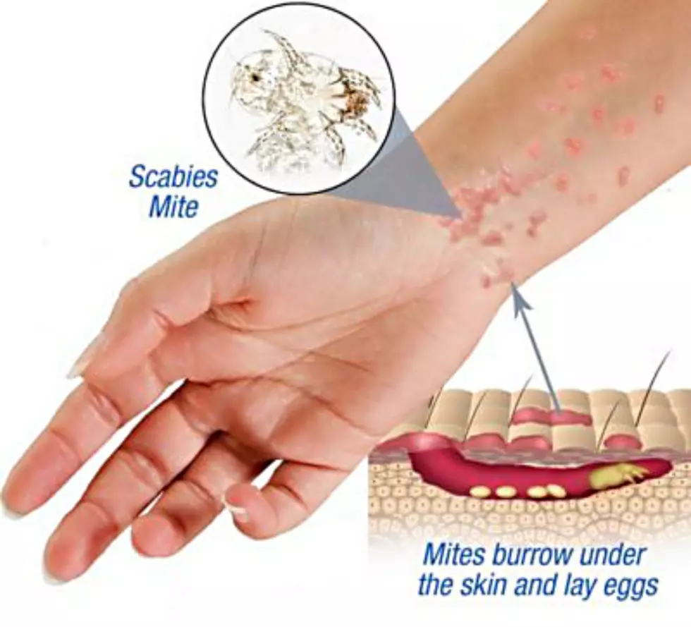 Scabies on wrist. (Saratoga County, N.Y. Health Dept.)