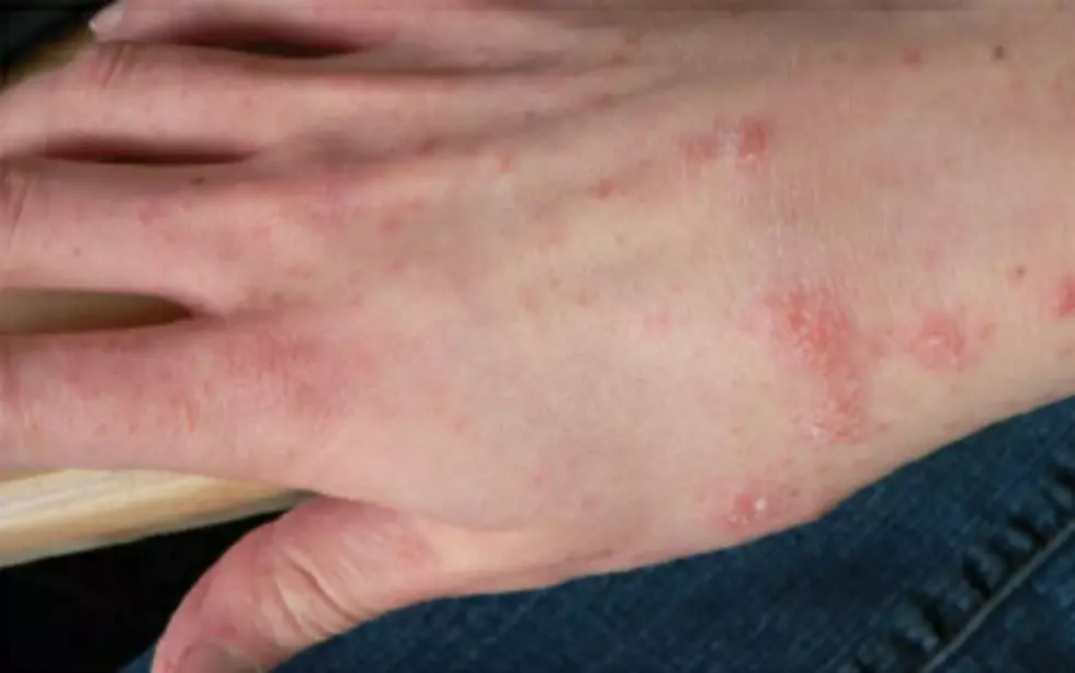 Scabies on hand